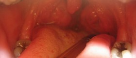 Remedies for strep throat
