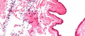 Remedies for Spermatocele