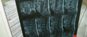Diagnosed with a herniated disc? What to do next…