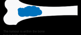 Hormone therapy for bone cancer