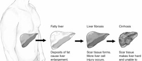 Liver damage symptoms