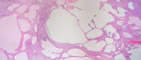 A cyst on the fallopian tube?