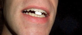 Chronic postoperative pain