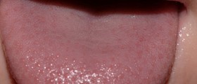 Inflamed taste buds