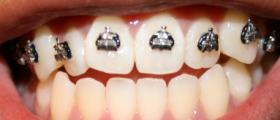 About overbite surgery