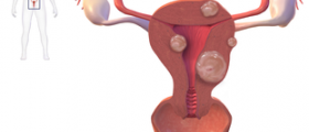 The true cost of uterine fibroids?