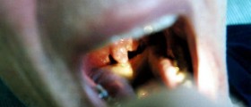 Throat cancer survival rate
