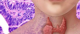 Prevention of myxedema coma