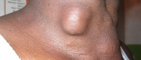 Signs and symptoms of thyroid cancer