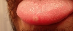 Cold sores on tongue