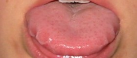 Tongue swelling facts