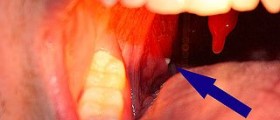 Prevention of tonsil stones