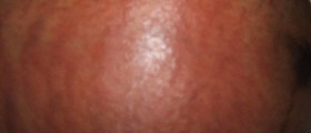 PUPPP relief and treatment