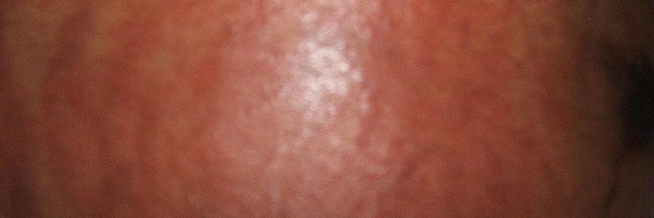 PUPPP relief and treatment