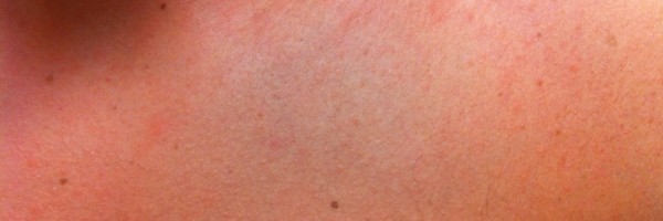 Ringworm: what is it, and how do you treat it?