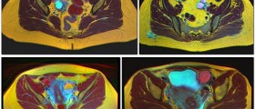 Ovarian cysts effective prevention uncovered