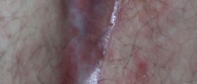 Chronic pilonidal sinus