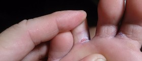 Acute vesicular athlete’s foot