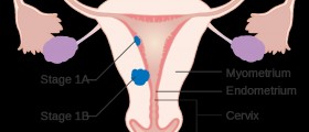 Uterine cancer deaths on the rise