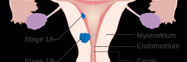 Uterine cancer deaths on the rise