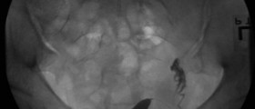 What is a unicornuate uterus?