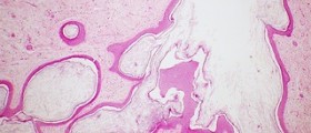 What is an ovarian dermoid cyst?