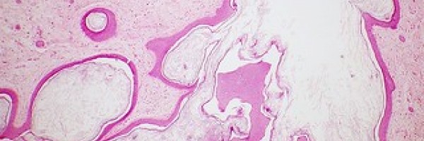 What is an ovarian dermoid cyst?