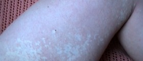 White spots caused by skin fungus