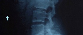 Causes of lower back and hip pain