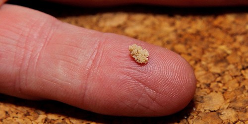 Kidney Stones Alert : Symptoms And Treatment