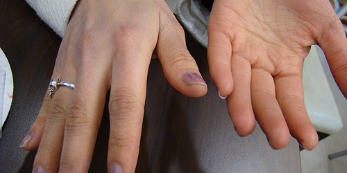 A Complete Guide To Understanding Lupus