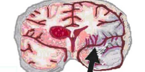 Reducing Stroke Severity With Regular Exercise