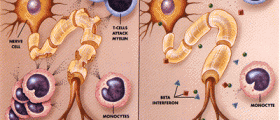 End MS Set To Raise Millions For Finding Multiple Sclerosis Cure