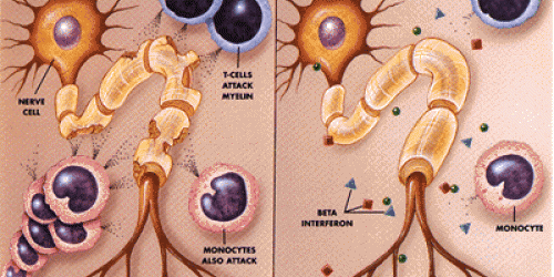 End MS Set To Raise Millions For Finding Multiple Sclerosis Cure