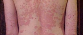 Biologics - New Treatment Hope For Psoriasis Sufferers