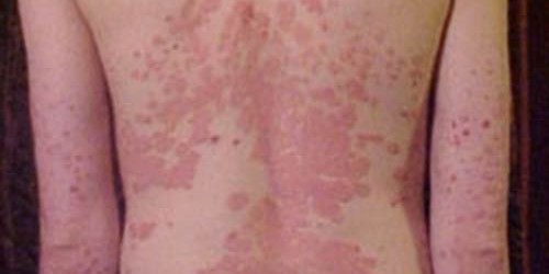Biologics - New Treatment Hope For Psoriasis Sufferers