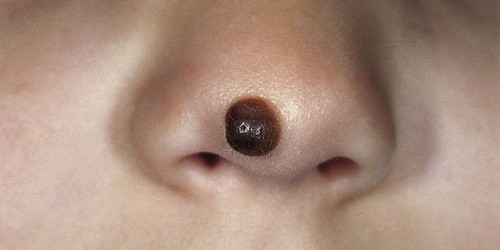 Most Common Types Of Birthmarks And Their Danger Levels