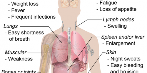 Leukemia: The Blood Cancer