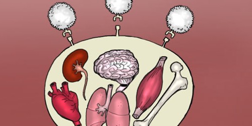 Lupus: When The Immune System Fires Against Its Own Mates