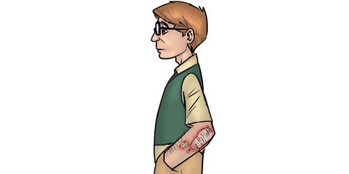 Living With Psoriasis