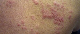What Are Shingles And Are You At Risk?