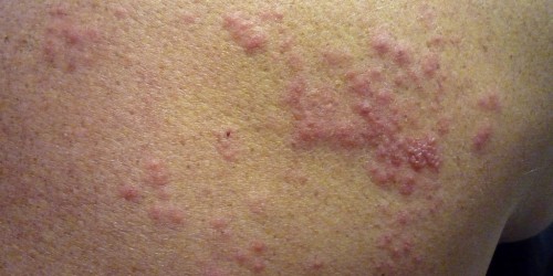 What Are Shingles And Are You At Risk?