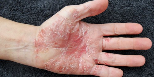 Manage and Track Psoriasis With Mobile Medical Apps