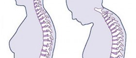 Osteoporosis Can Strike at Thirty