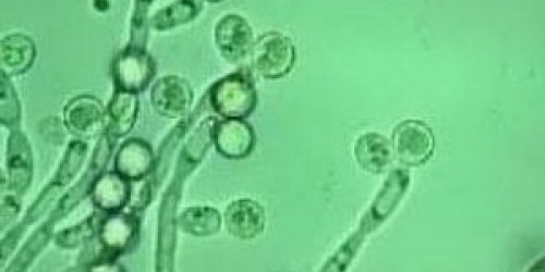 Diagnosed with Candida Infection! What now?