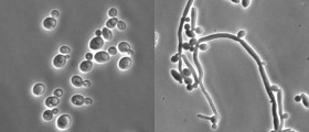 Vulvovaginal candidiasis (Vaginal thrush) therapy