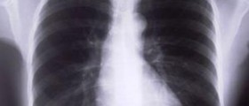 Cystic Fibrosis: Causes & Risk factors