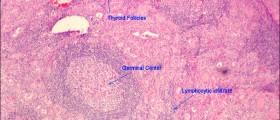 Hashimoto's Disease & Hyperthyroidism