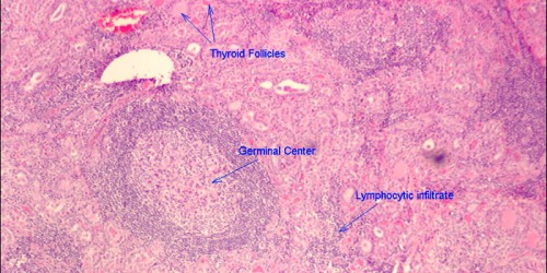 Hashimoto's Disease & Hyperthyroidism