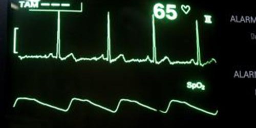 Supraventricular tachycardia: Long term side effects